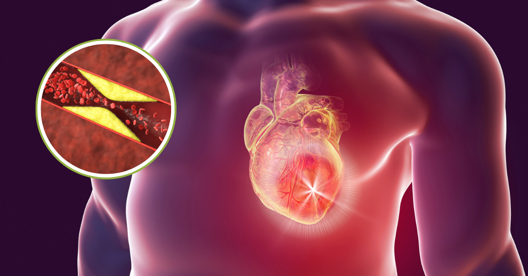Why Humans Are Prone to Coronary Artery Disease – Part 2